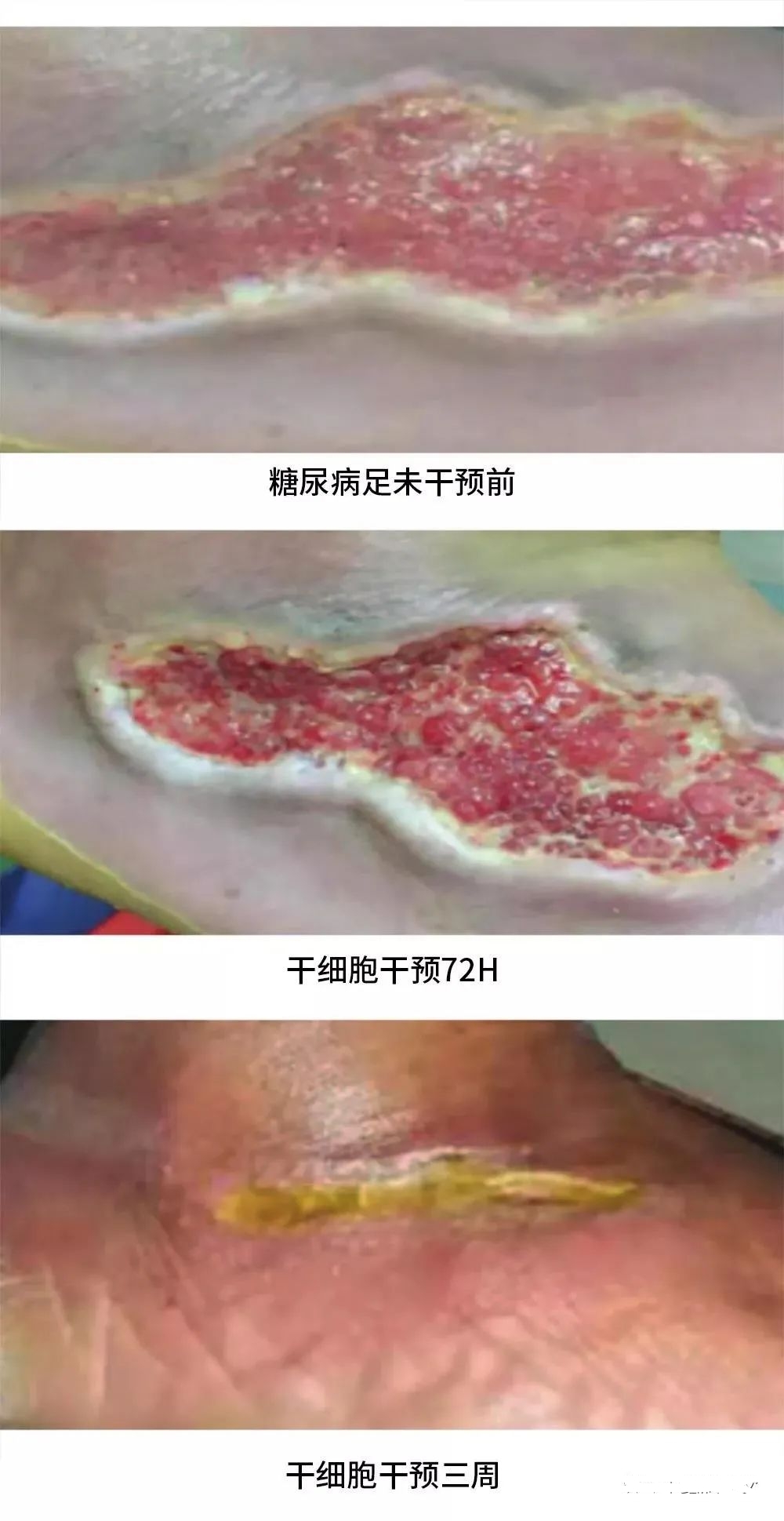 患者治療72小時(shí)化膿性分泌物和傷口大小明顯減少，3周后足部潰瘍幾乎愈合，足部行走功能也得到了恢復。