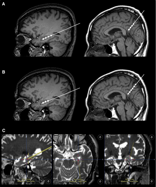 干細胞立體定向注射患者的右海馬體和右前丘盤(pán)