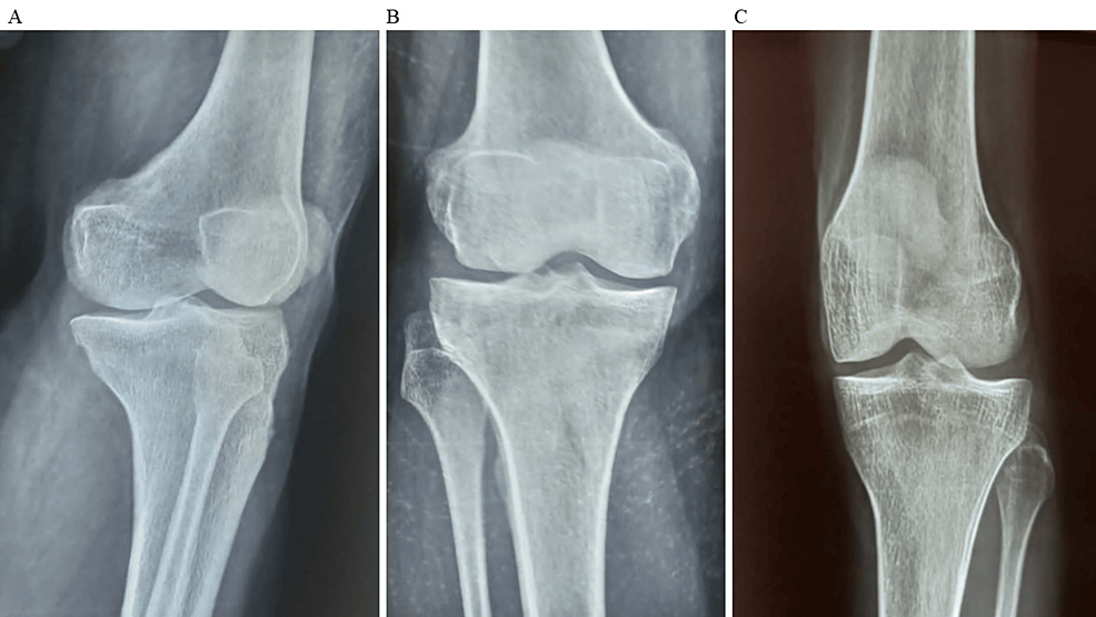 圖2：顯示了開(kāi)始干細胞治療后骨骼的側視圖和前后視圖