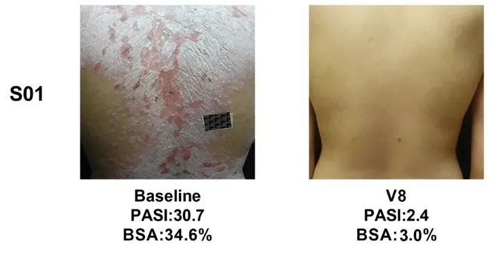 同種異體UMSCs的移植對銀屑病患者安全且部分有效，尤其對女性銀屑病患者