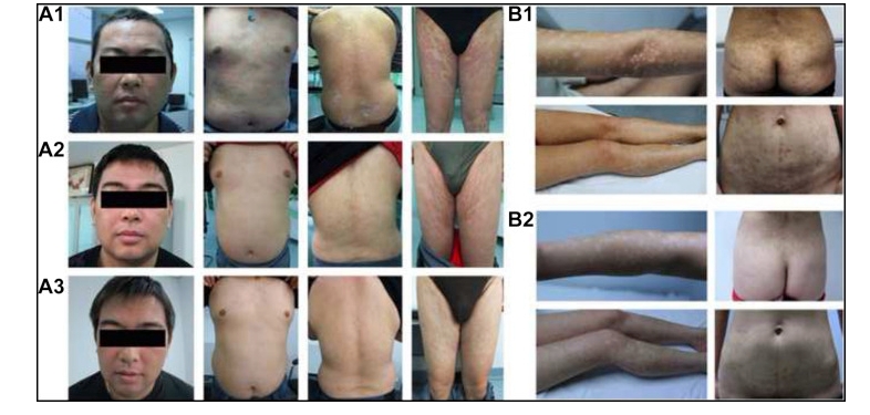兩例尋常型銀屑病患者通過(guò)臍帶間充質(zhì)干細胞（UC-MSCs）治療，兩例患者均在4至5年內未復發(fā)。