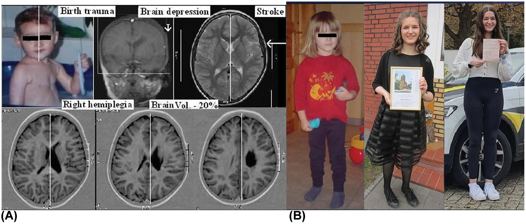 創(chuàng  )傷是先天性腦癱的危險因素