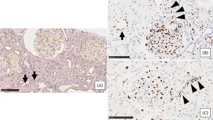 在住院第31天進(jìn)行的腎活檢結果