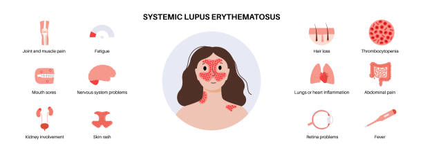 紅斑狼瘡會(huì )對患者壽命造成影響嗎？
