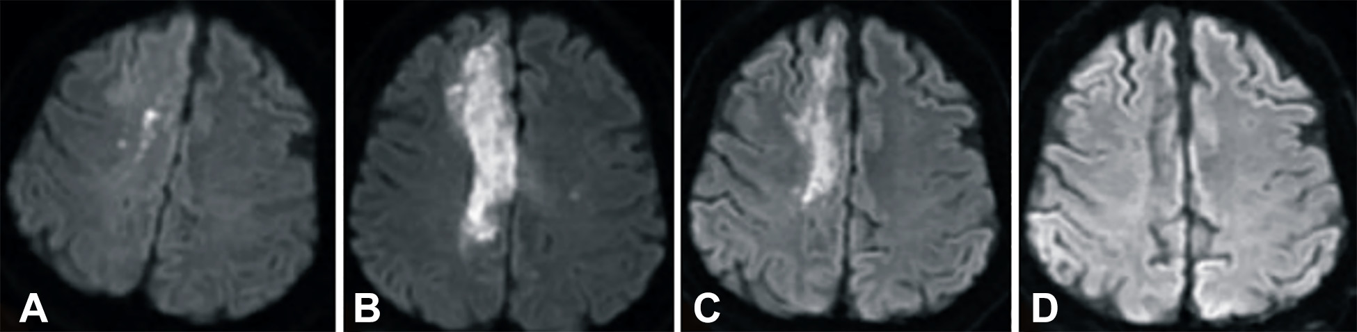 卒中發(fā)病后2小時(shí)和單核細胞臍帶血輸注后6個(gè)月獲得的彌散加權圖像