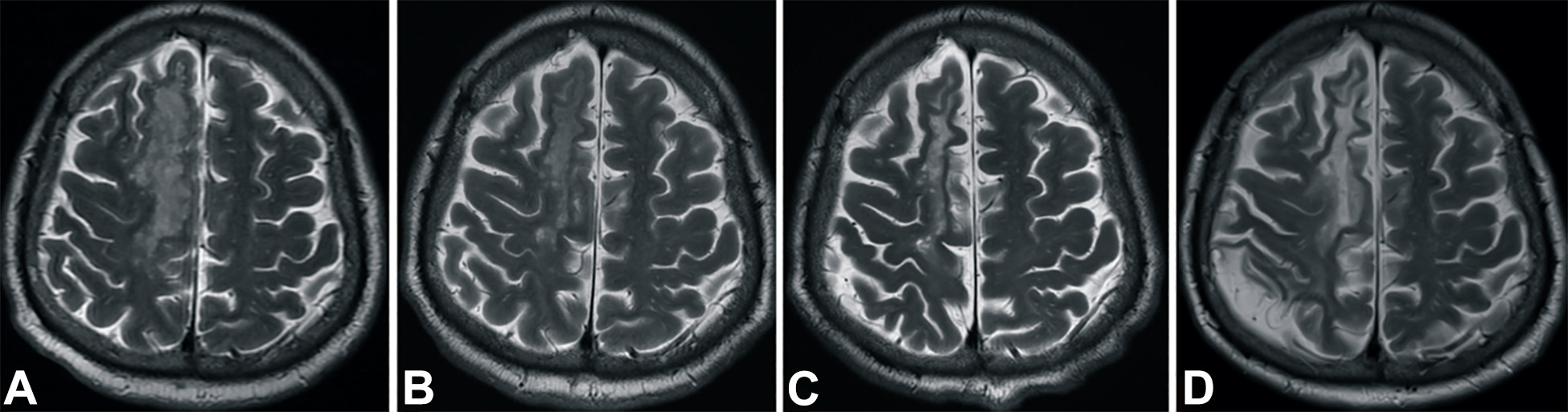 中風(fēng)后2小時(shí)和輸血后6個(gè)月獲得的T2加權圖像。