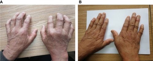 （圖1A）表現為雙手不能伸直。

（圖1B）治療3年后，停用抗風(fēng)濕藥物5年，雙手伸展自如，關(guān)節周?chē)L(fēng)濕結節逐漸變軟、消退。