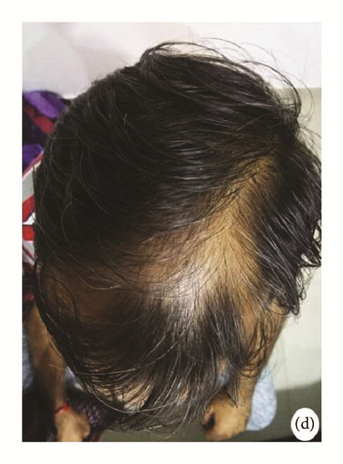 局部應用骨髓間充質(zhì)干細胞一個(gè)月后，銀屑病消退，炎性紅斑完全清除（d）。