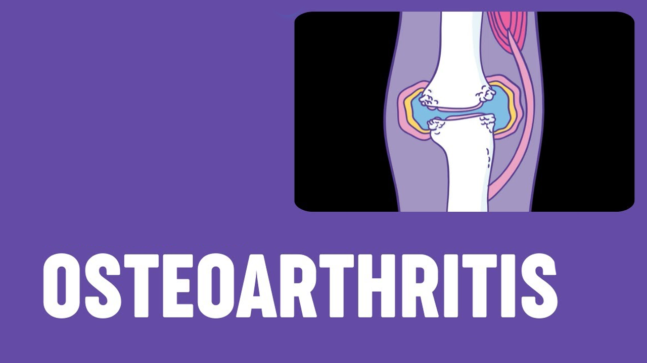 5項研究171例患者，評估干細胞治療骨關(guān)節炎的安全性和有效性