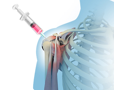 間充質(zhì)干細胞需要注射幾次才會(huì )有效果?