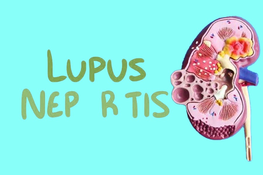 干細胞治療狼瘡性腎炎：2019-2024年臨床研究進(jìn)展回顧
