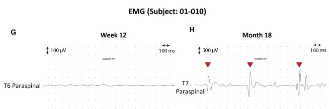 圖4：患者4腦運動(dòng)控制評估(BMCA)和EMG評估