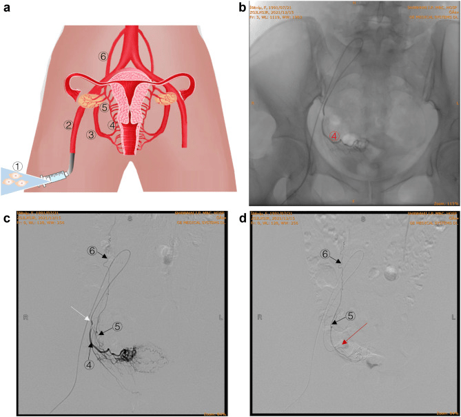 圖1：通過(guò)卵巢動(dòng)脈精確輸注hAEC