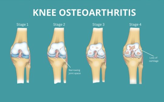 干細胞治療膝骨關(guān)節炎：患者臨床癥狀顯著(zhù)改善，減少炎癥，消除疼痛