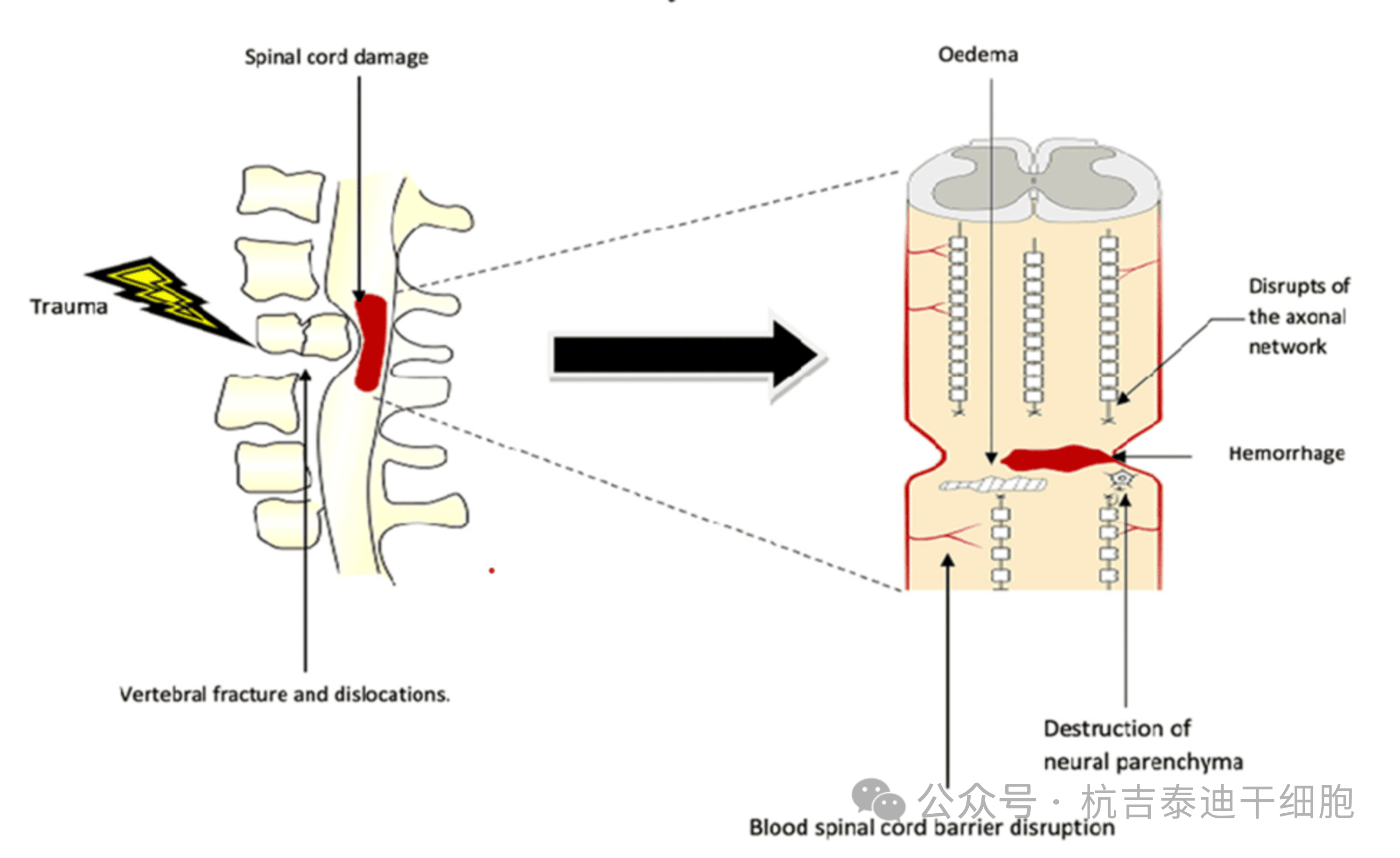 圖1：原發(fā)性病變，該圖顯示了創(chuàng  )傷的直接影響，包括椎骨骨折、脫位和脊髓損傷導致軸突斷裂、水腫、出血和神經(jīng)實(shí)質(zhì)破壞