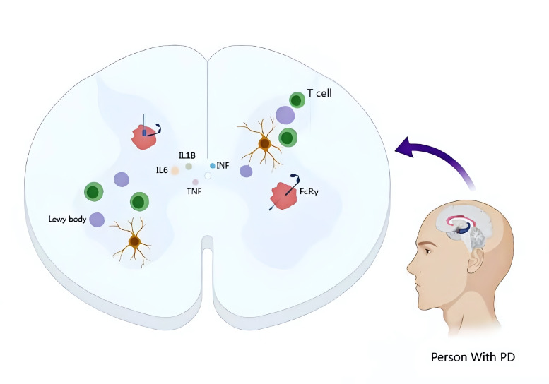 圖1:帕金森病的病理特征和神經(jīng)炎癥的作用 圖1:帕金森病的病理特征和神經(jīng)炎癥的作用