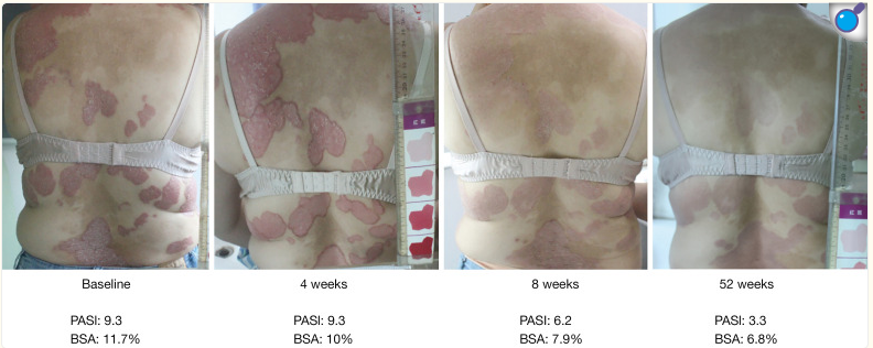 受試者治療前后的代表性皮膚圖像。