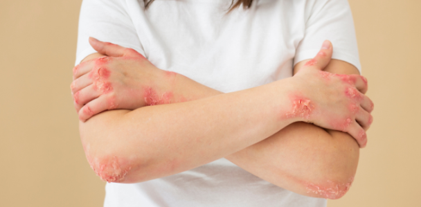 干細胞治療系統性紅斑狼瘡：如何實(shí)現從短期的疾病癥狀緩解到長(cháng)期的多器官功能改善？