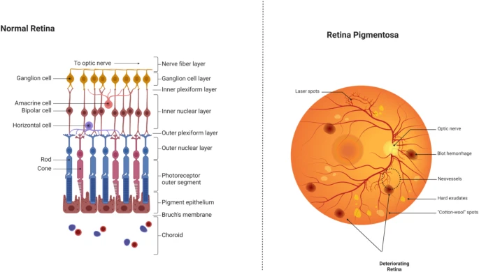 圖6：正常視網(wǎng)膜與受視網(wǎng)膜色素變性影響的視網(wǎng)膜的比較。