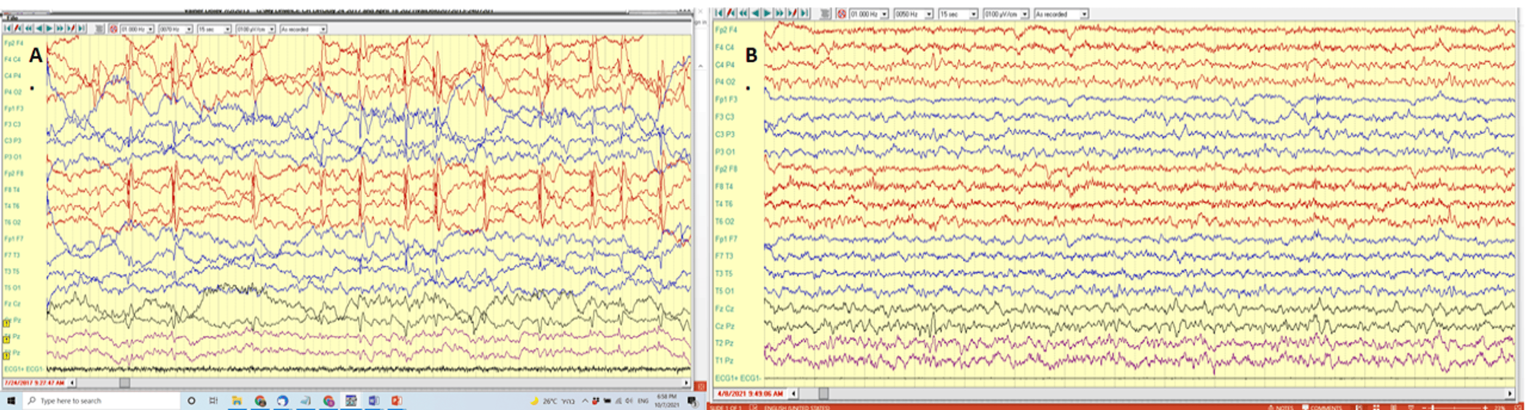 圖1：alloMSCT#1前后的腦電圖結果
