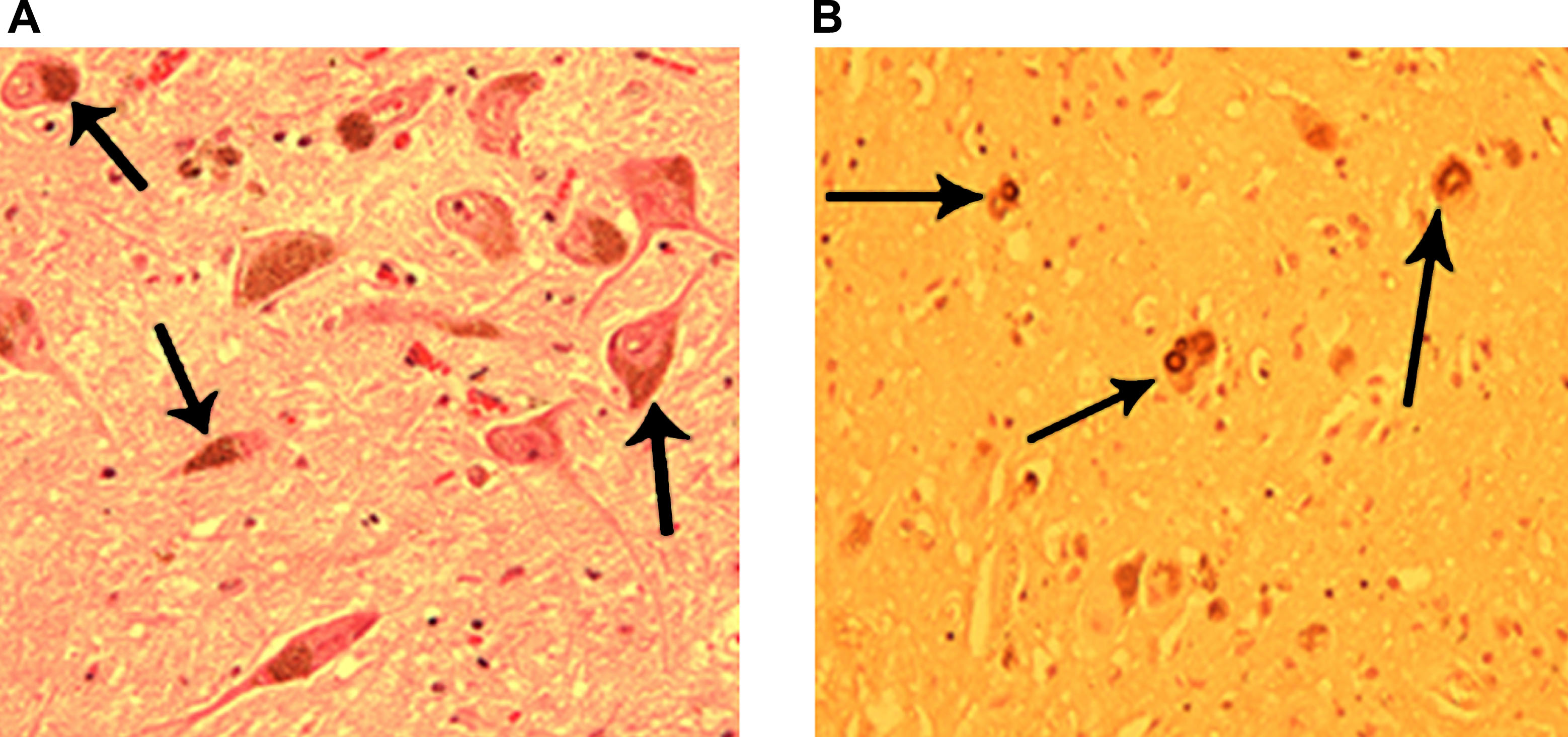 圖3：正常和帕金森病患者的黑質(zhì)。