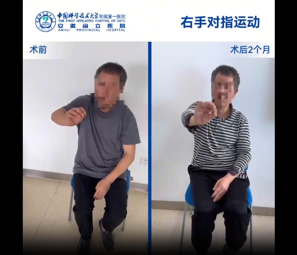 國內誘導多能干細胞療法新突破：首例早發(fā)型帕金森病成功給藥，當天即可行走