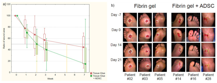 圖1：纖維蛋白凝膠組和AASC組患者治療進(jìn)展對比。