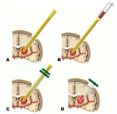 神經(jīng)內鏡輔助下腦內血腫清除術(shù)示意圖