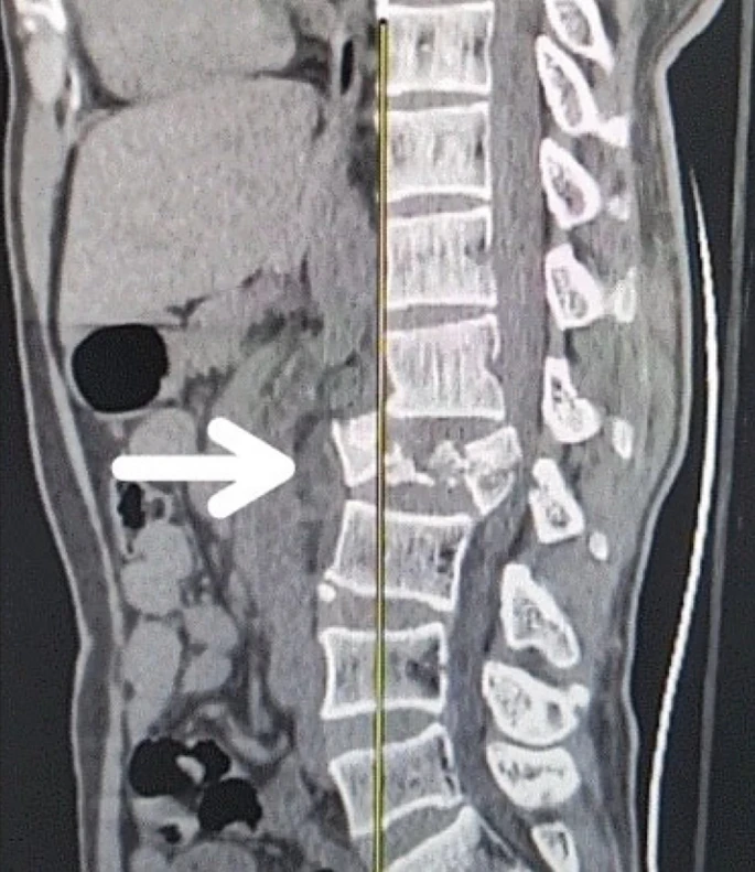 圖1：X射線(xiàn)圖像顯示脊髓損傷，椎骨骨折和移位，如白色箭頭所示
