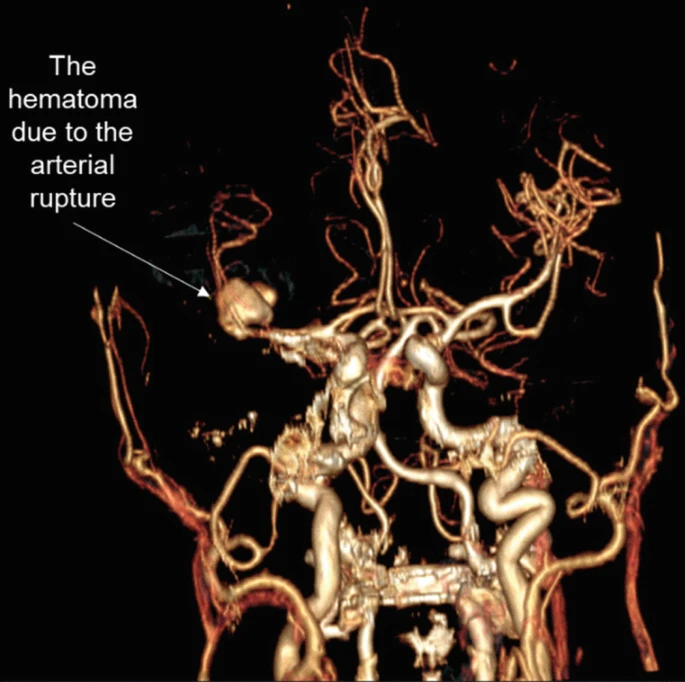 圖2：出血導致中風(fēng)