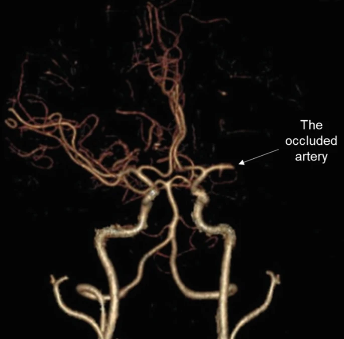 圖1：動(dòng)脈閉塞導致的缺血性中風(fēng)