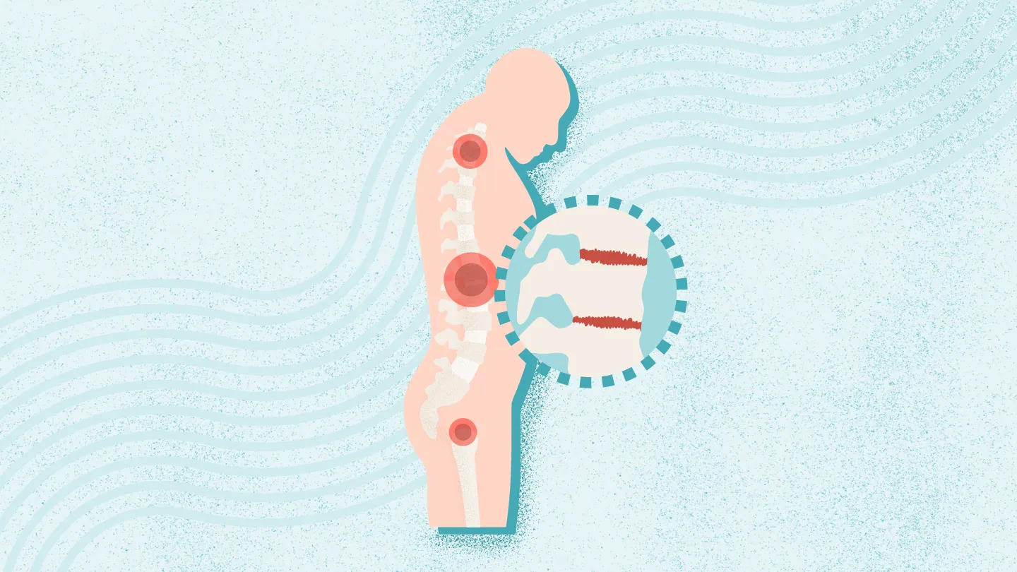 2025年干細胞治療強直性脊柱炎最新臨床進(jìn)展（截至12月）