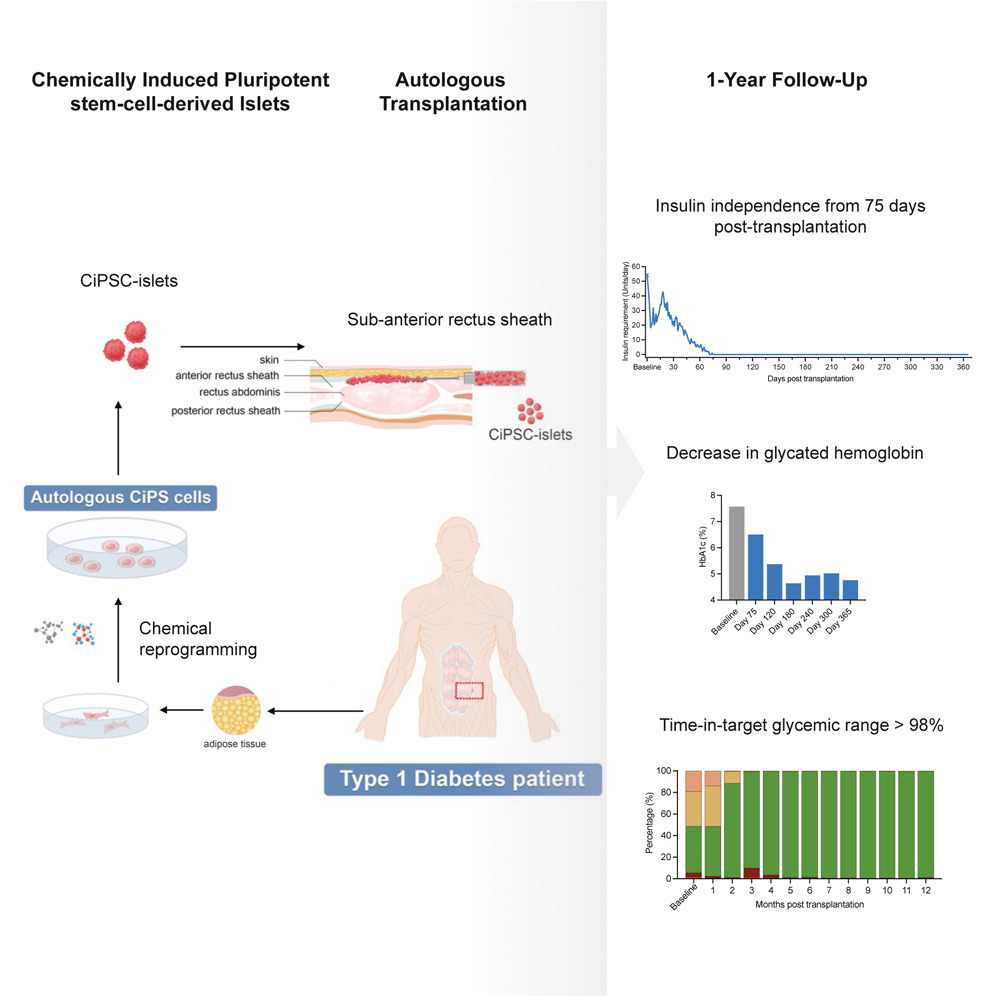 化學(xué)誘導多能干細胞衍生的胰島自體移植一年隨訪(fǎng)