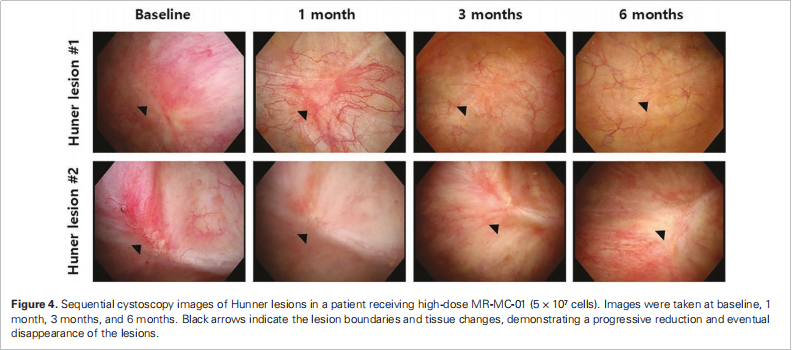間質(zhì)性膀胱炎臨床試驗
