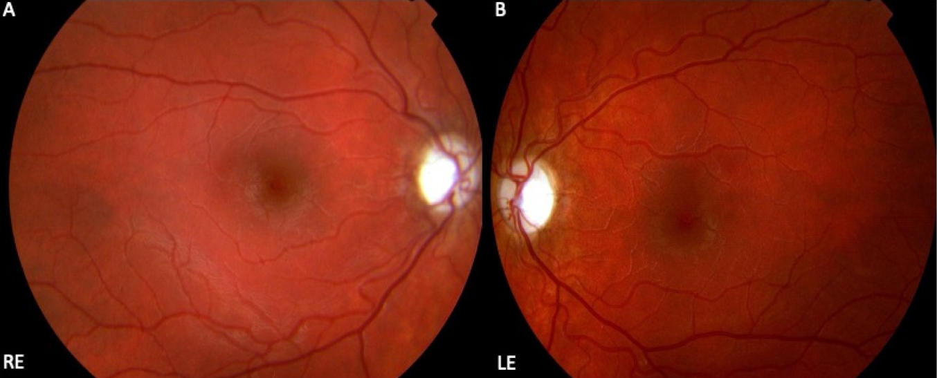 遺傳性視神經(jīng)病變 遺傳性視神經(jīng)病變