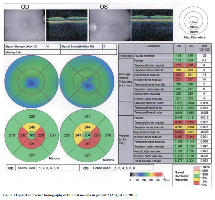 遺傳性視神經(jīng)病變臨床試驗 遺傳性視神經(jīng)病變臨床試驗