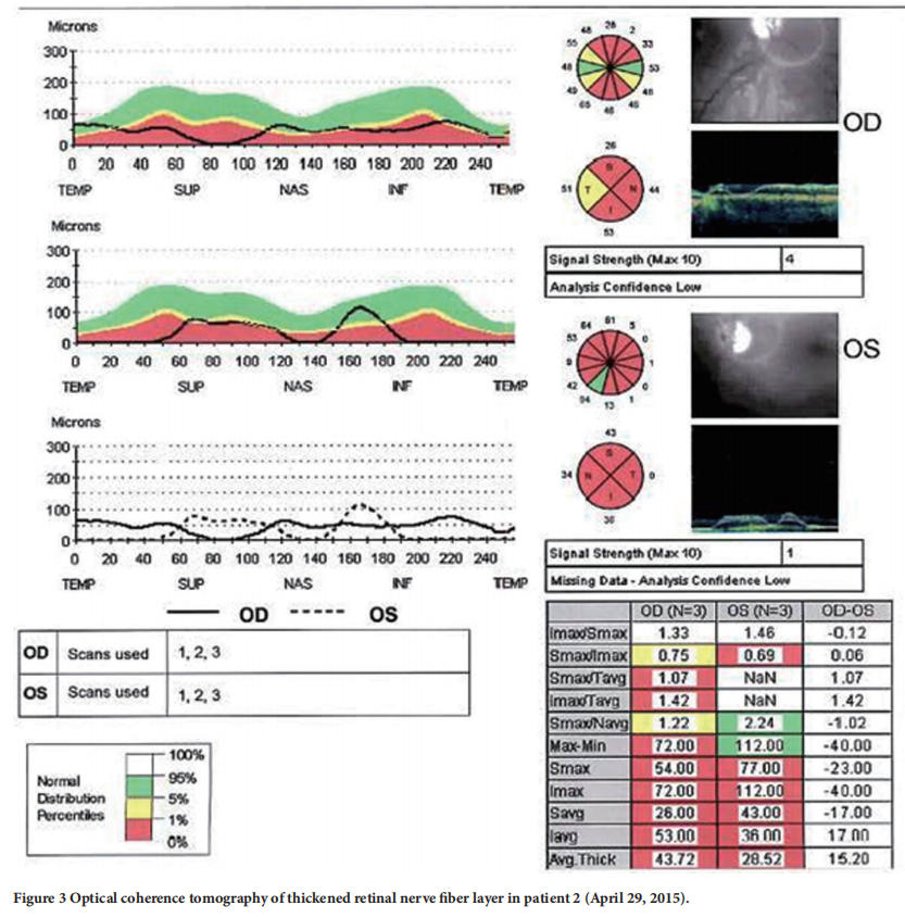 遺傳性視神經(jīng)病變臨床試驗 遺傳性視神經(jīng)病變臨床試驗