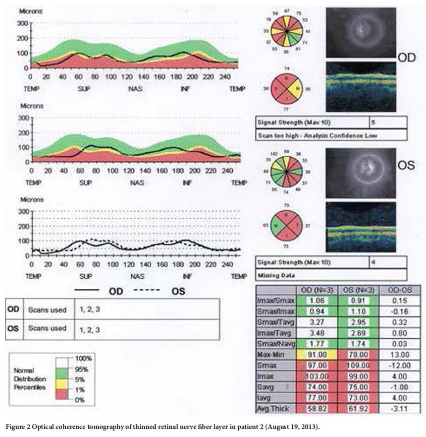 遺傳性視神經(jīng)病變臨床試驗 遺傳性視神經(jīng)病變臨床試驗
