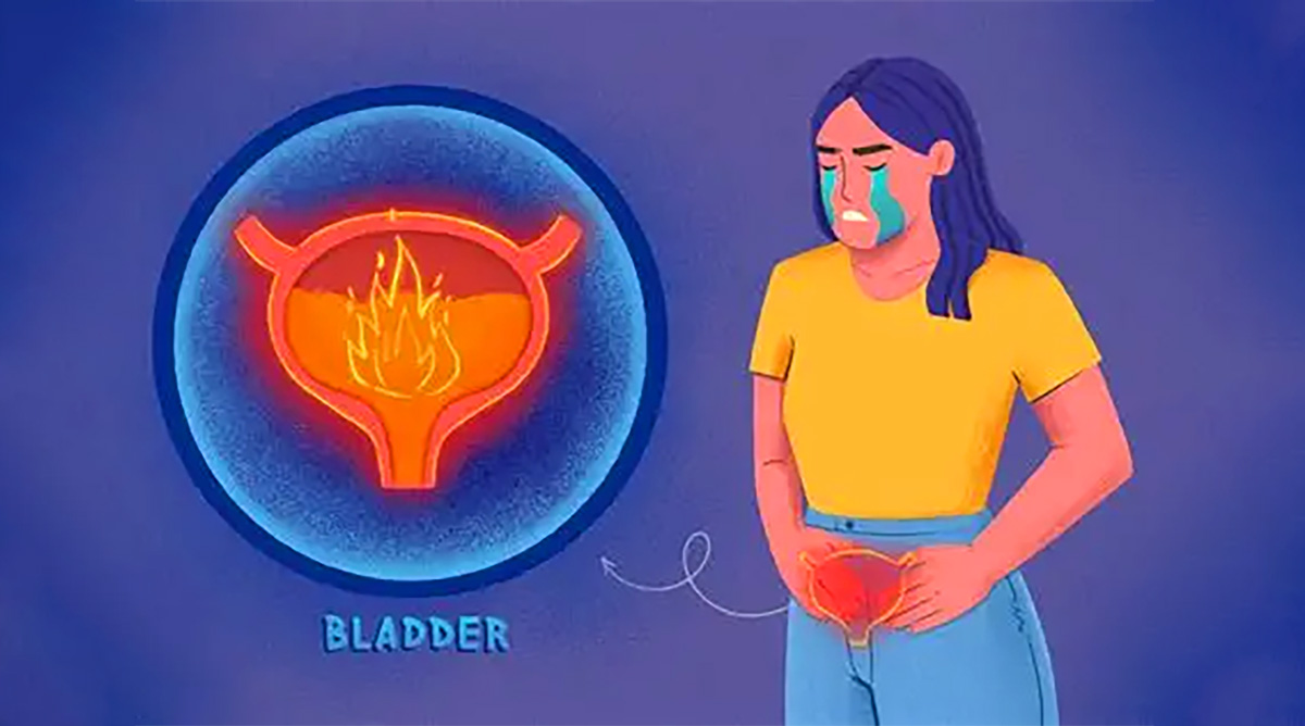 間質(zhì)性膀胱炎