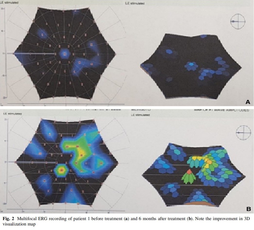 視神經(jīng)萎縮臨床試驗