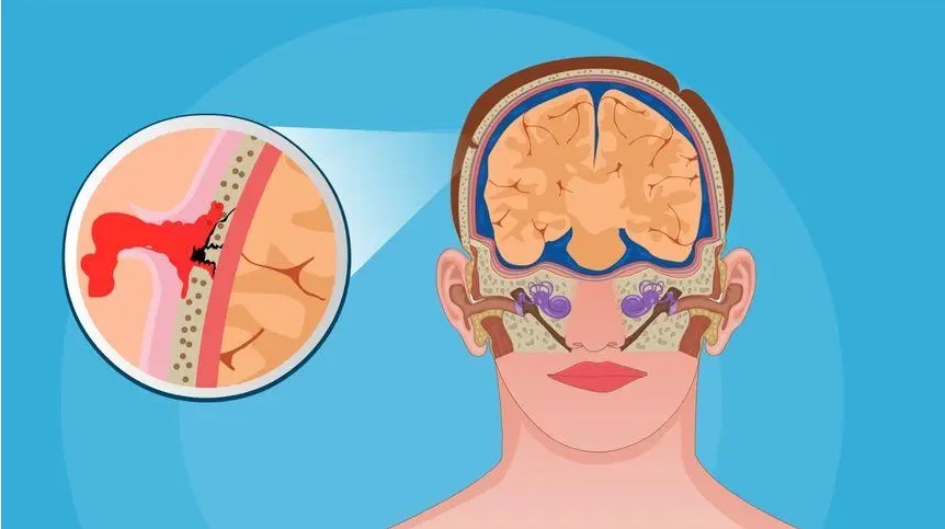 創(chuàng  )傷性腦損傷
