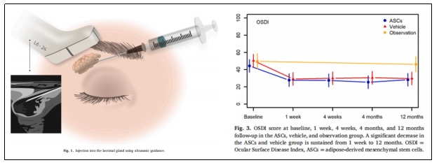 干細胞治療 干細胞治療