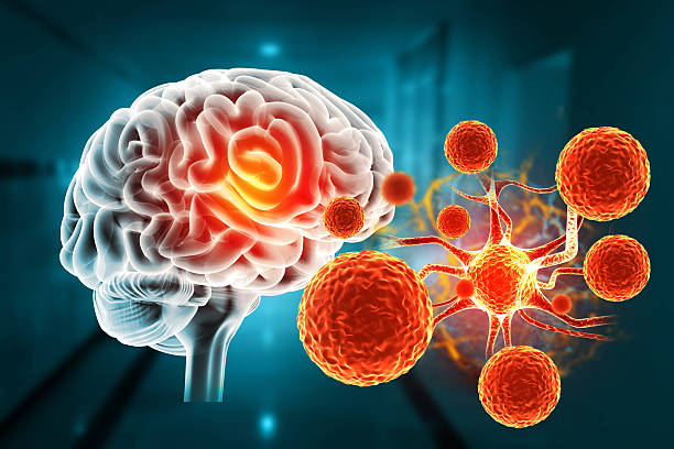 干細胞治療帕金森病取得新進(jìn)展！II期臨床證實(shí)：三次輸注，安全且運動(dòng)功能得到改善