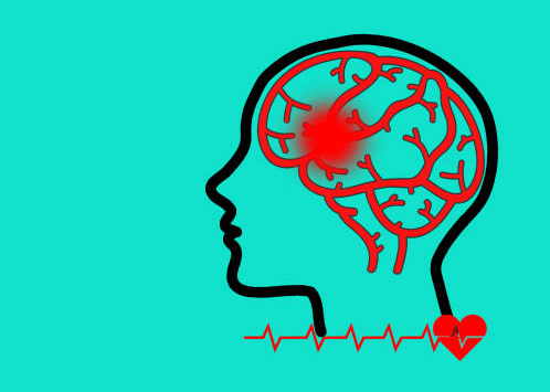 哪些中風(fēng)患者適合干細胞治療？專(zhuān)家公布了5大評估標準