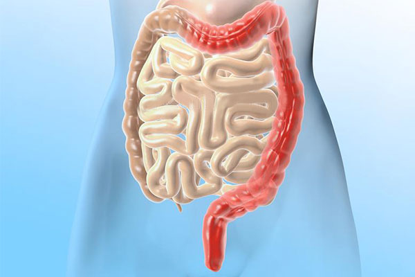 潰瘍性結腸炎新希望：干細胞移植2個(gè)月緩解率達7成，4成患者實(shí)現粘膜愈合