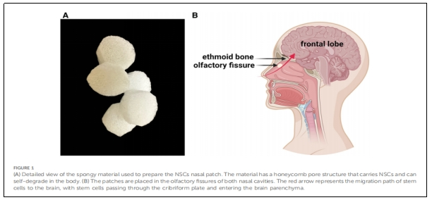 圖1：用于制備N(xiāo)SCs鼻貼片的海綿狀材料的詳細視圖。