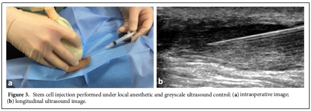 圖3.在局部麻醉和灰階超聲控制下進(jìn)行的干細胞注射
