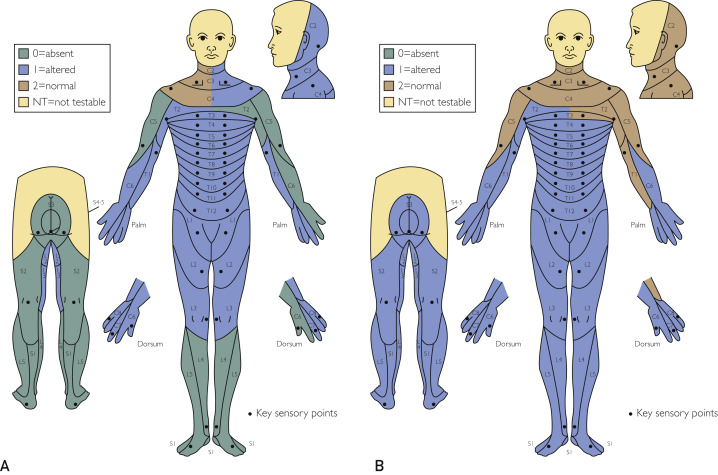 圖2：根據脊髓損傷神經(jīng)學(xué)分類(lèi)國際標準，在基線(xiàn)（A）和 18 個(gè)月隨訪(fǎng)（B）時(shí)形成的皮節感覺(jué)評分。