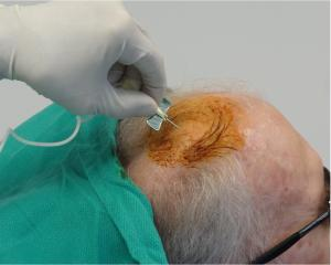 干細胞注射到大腦過(guò)程。