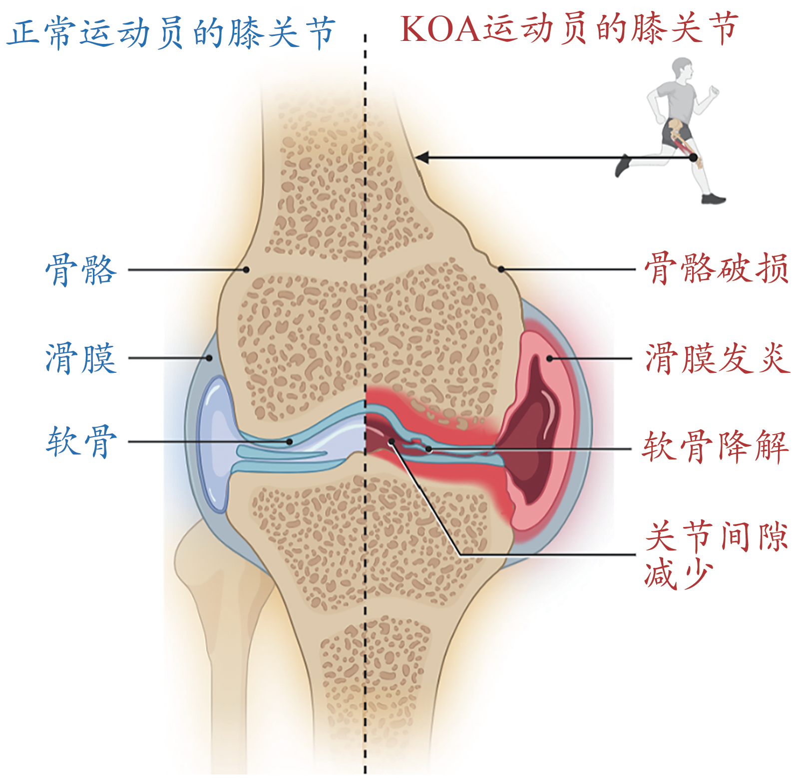 圖1：正常運動(dòng)員與KOA運動(dòng)員的膝關(guān)節